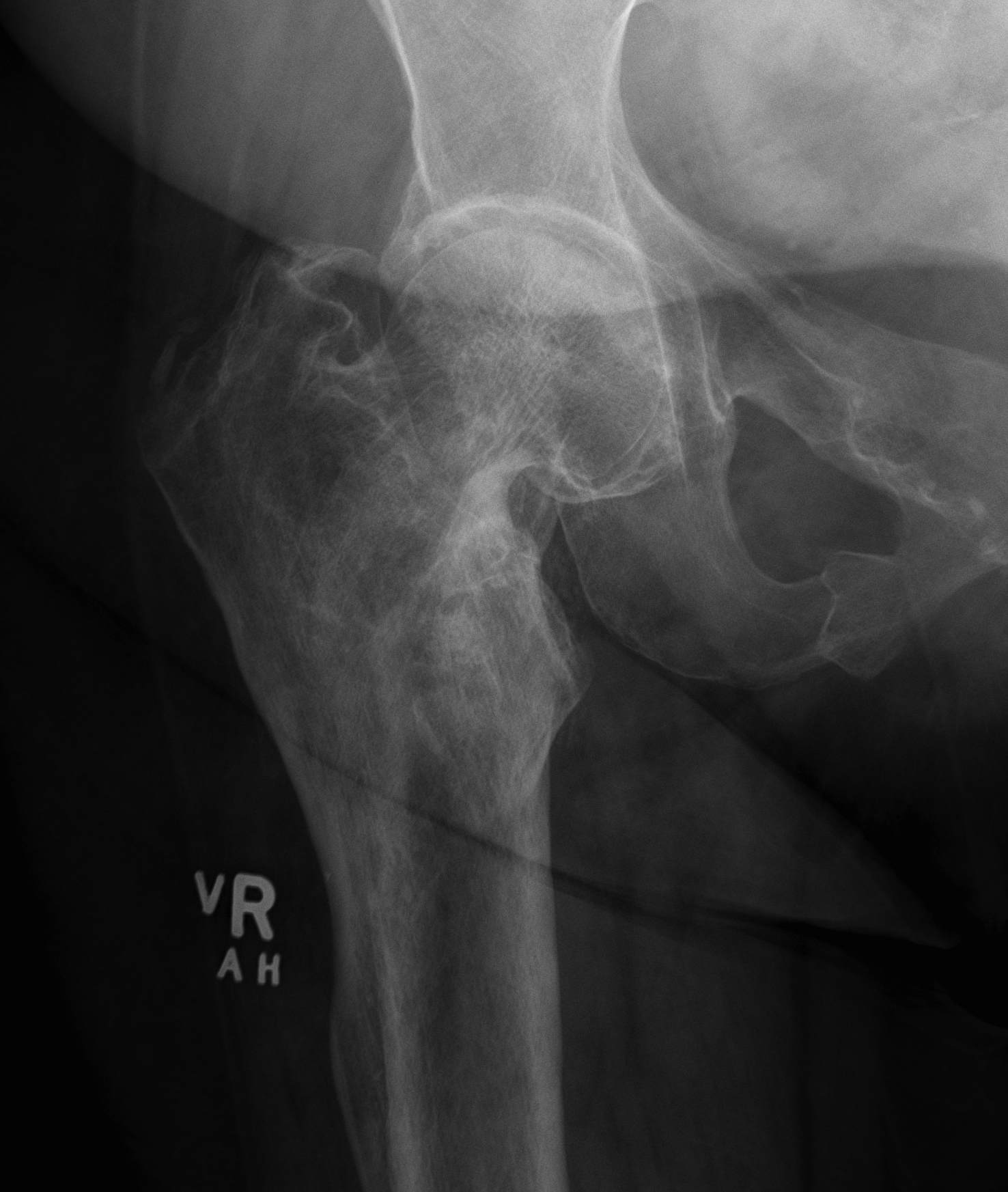 Hip OA Post NOF Fracture
